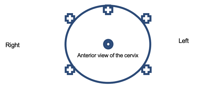 Paracervical Block.png